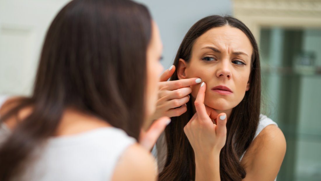 ¿Espinillas en tus treinta? Bienvenida al club de las adult acne survivors