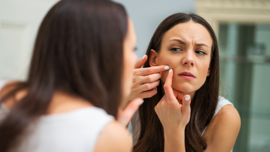 ¿Espinillas en tus treinta? Bienvenida al club de las adult acne survivors