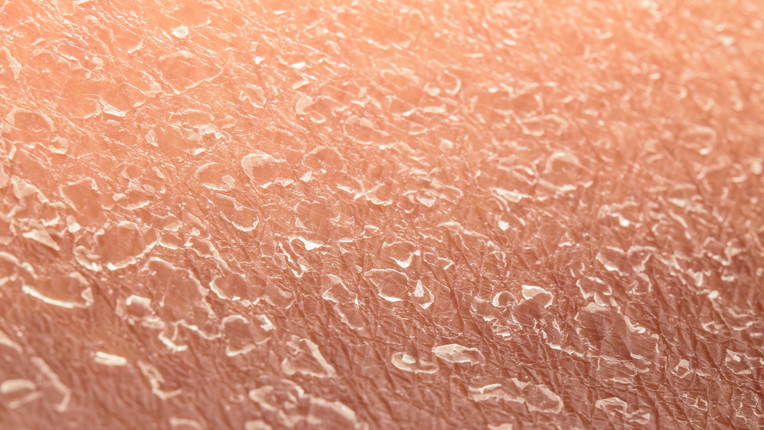 Entendiendo el Eczema Asteatótico o Dermatosis Craquelé