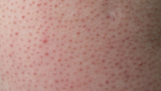 Entendiendo la Queratosis Pilaris: Cuando Aparece en la Cara