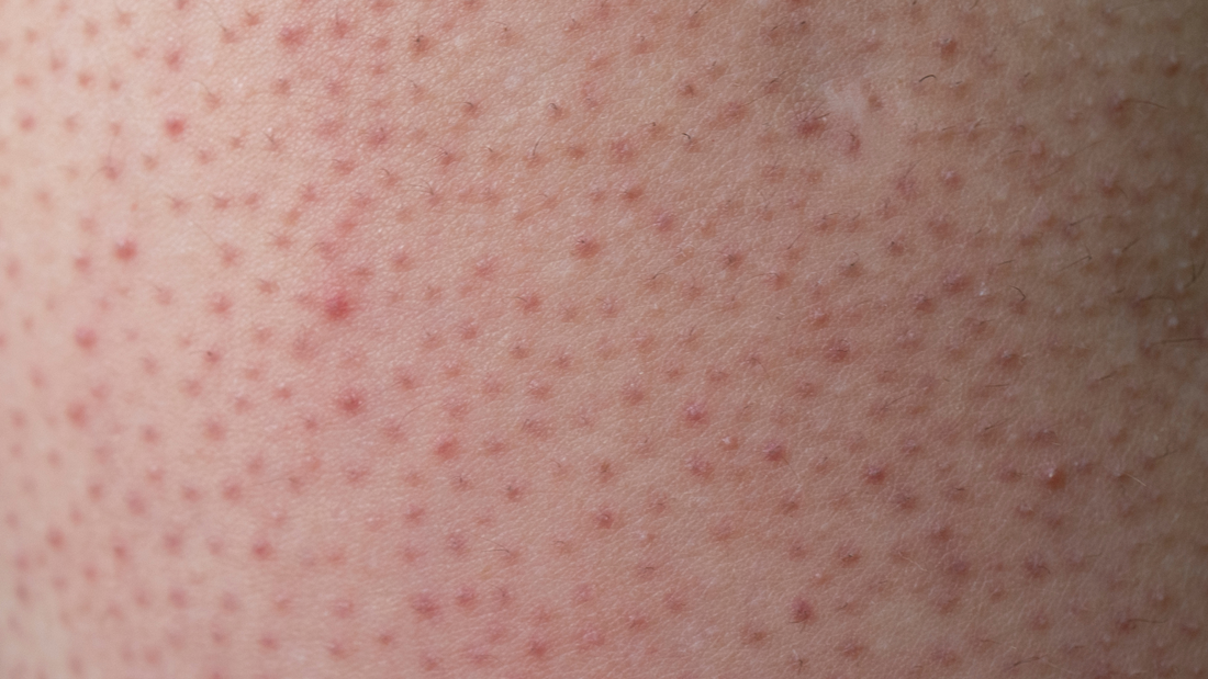 Entendiendo la Queratosis Pilaris: Cuando Aparece en la Cara